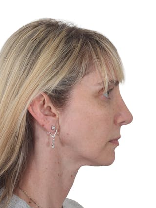 Rhinoplasty Before & After Gallery - Patient 177144 - Image 2