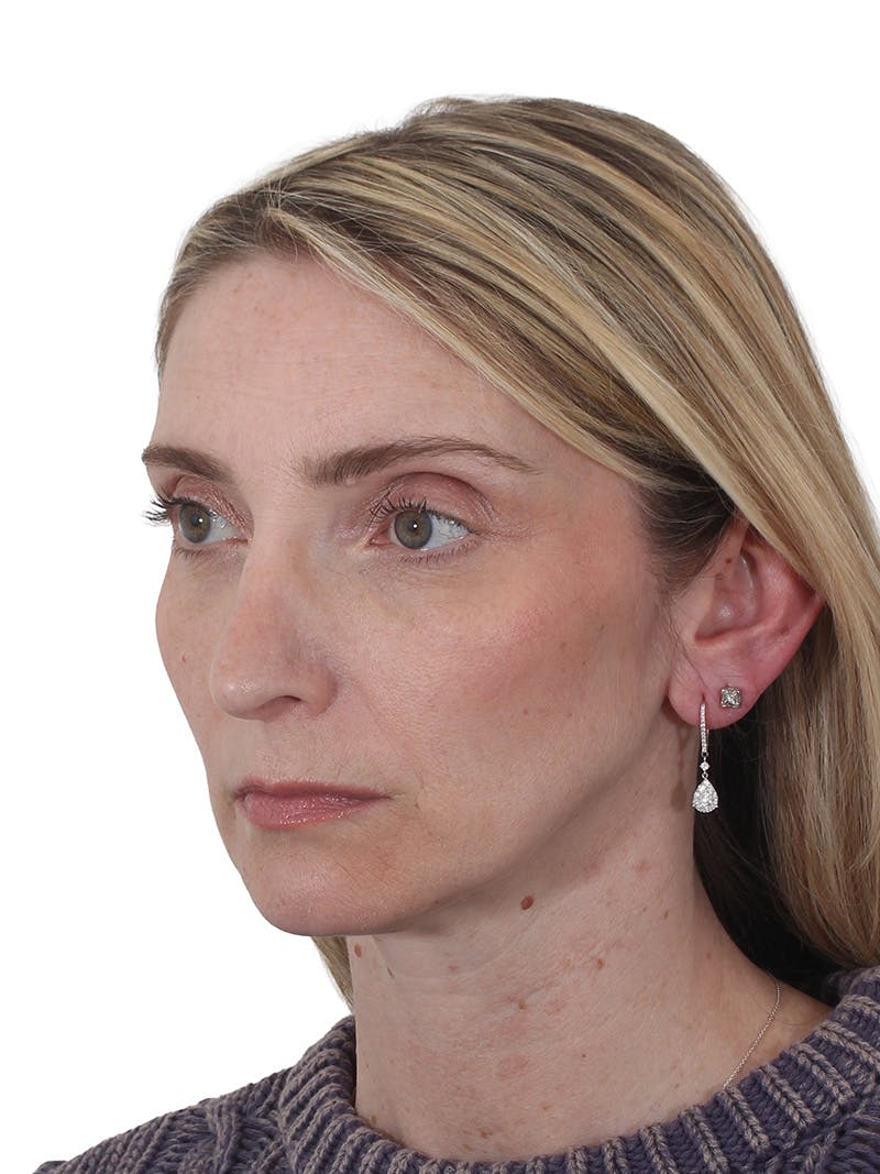 Rhinoplasty Before & After Gallery - Patient 177144 - Image 7