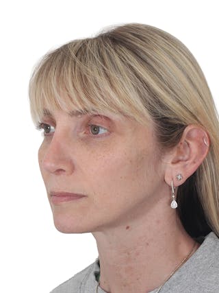 Rhinoplasty Before & After Gallery - Patient 177144 - Image 8