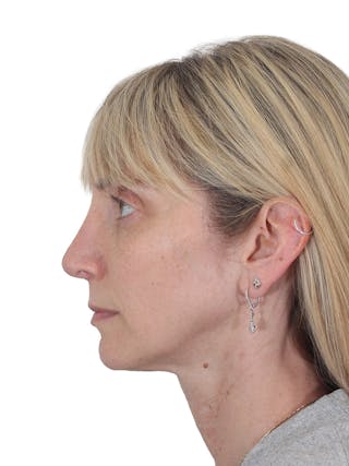 Rhinoplasty Before & After Gallery - Patient 177144 - Image 10