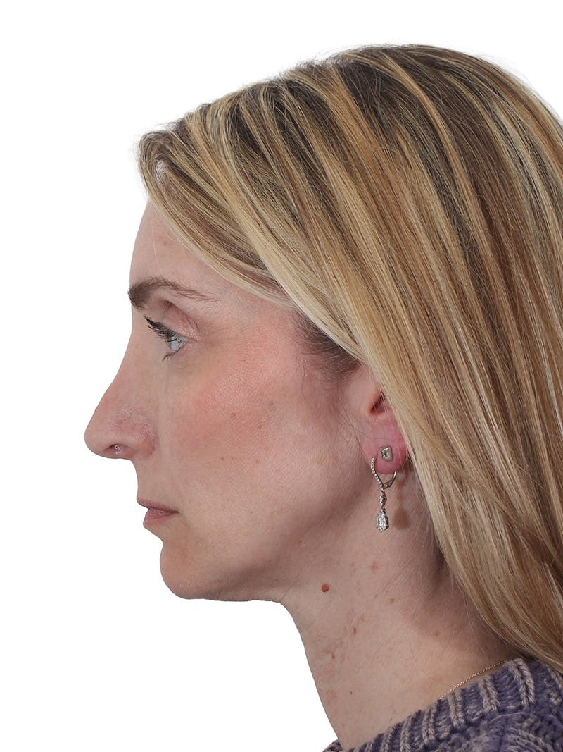 Rhinoplasty Before & After Gallery - Patient 177144 - Image 9