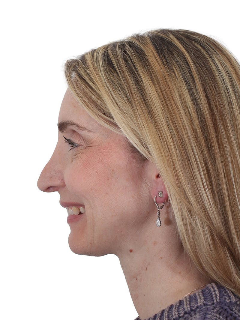Rhinoplasty Before & After Gallery - Patient 177144 - Image 11