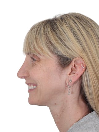 Rhinoplasty Before & After Gallery - Patient 177144 - Image 12