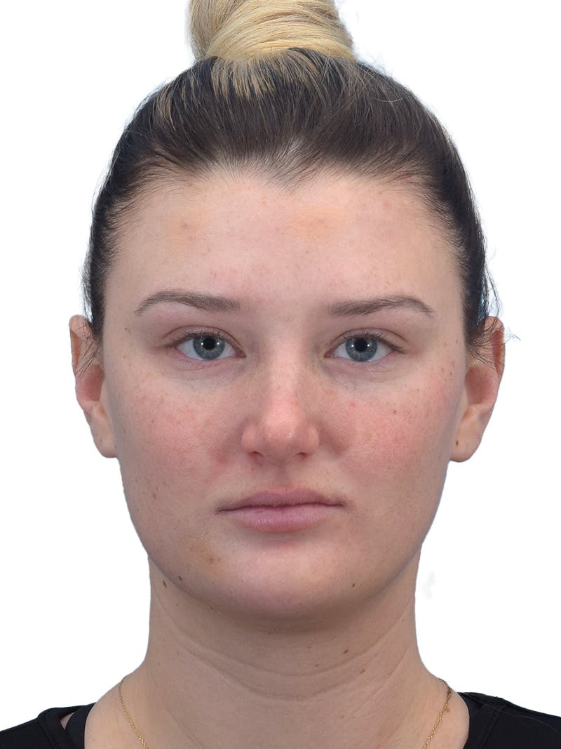 Rhinoplasty Before & After Gallery - Patient 306260 - Image 3