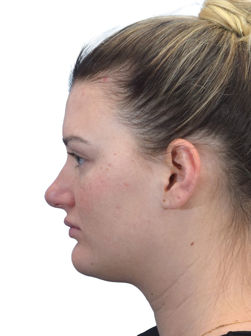 Rhinoplasty Before & After Gallery - Patient 306260 - Image 1