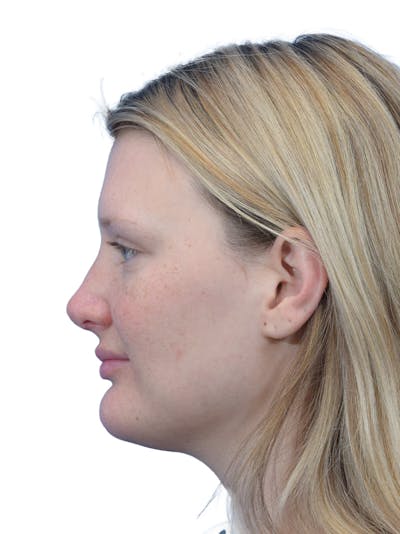 Rhinoplasty Before & After Gallery - Patient 306260 - Image 2