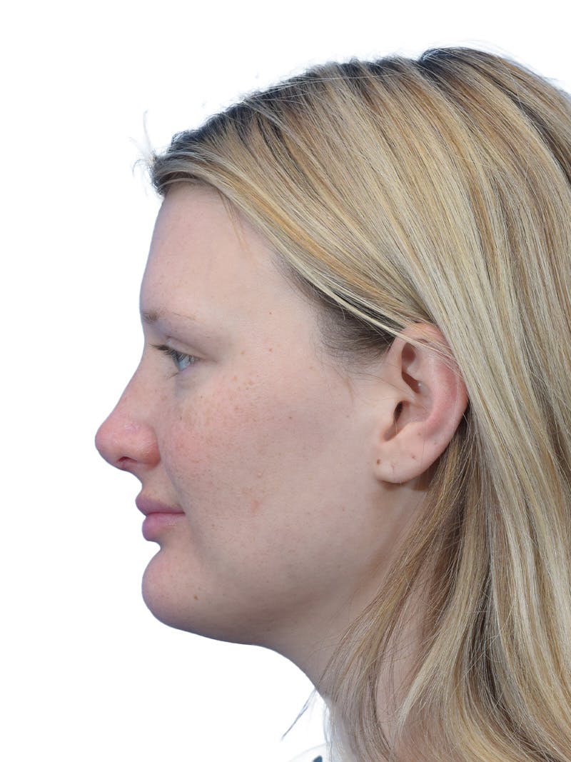 Rhinoplasty Before & After Gallery - Patient 306260 - Image 2