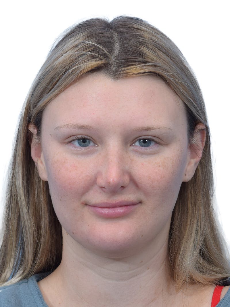 Rhinoplasty Before & After Gallery - Patient 306260 - Image 4