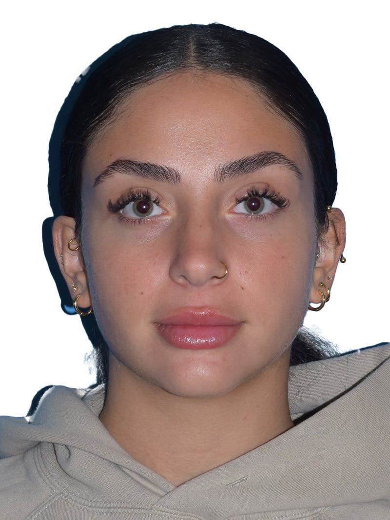 Rhinoplasty Before & After Gallery - Patient 394016 - Image 5