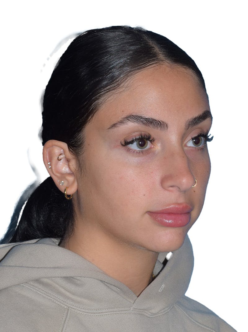 Rhinoplasty Before & After Gallery - Patient 394016 - Image 3