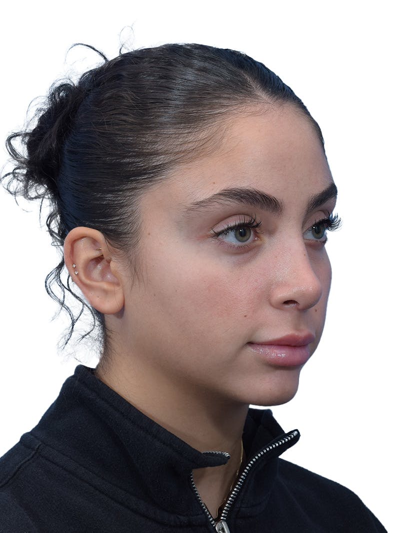 Rhinoplasty Before & After Gallery - Patient 394016 - Image 4
