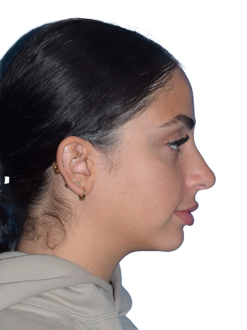 Rhinoplasty Before & After Gallery - Patient 394016 - Image 1