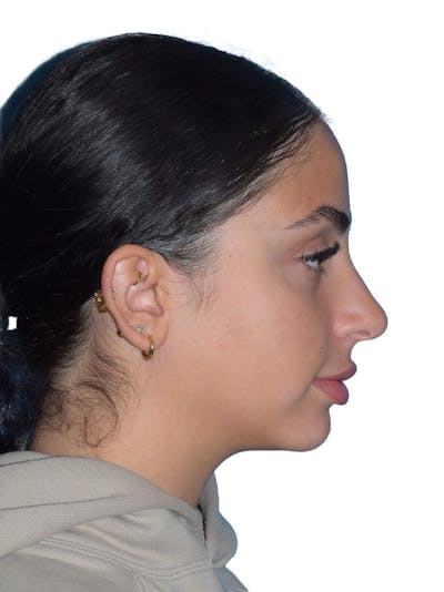 Rhinoplasty Before & After Gallery - Patient 394016 - Image 1