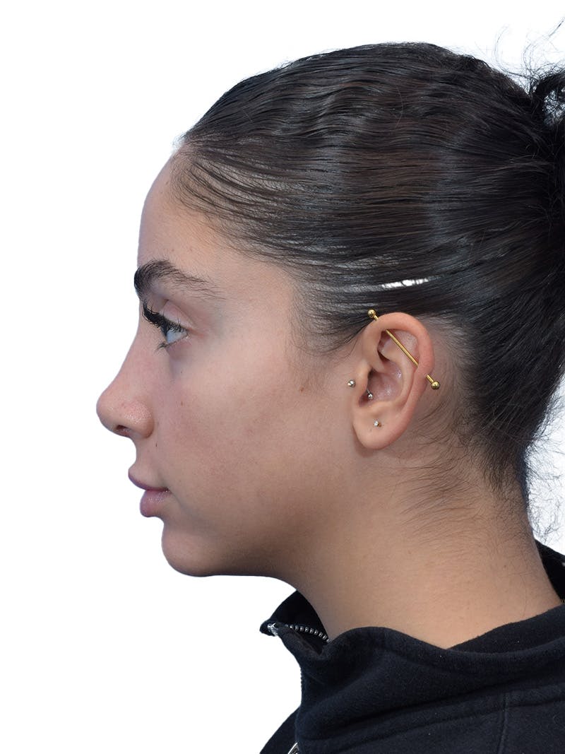 Rhinoplasty Before & After Gallery - Patient 394016 - Image 10