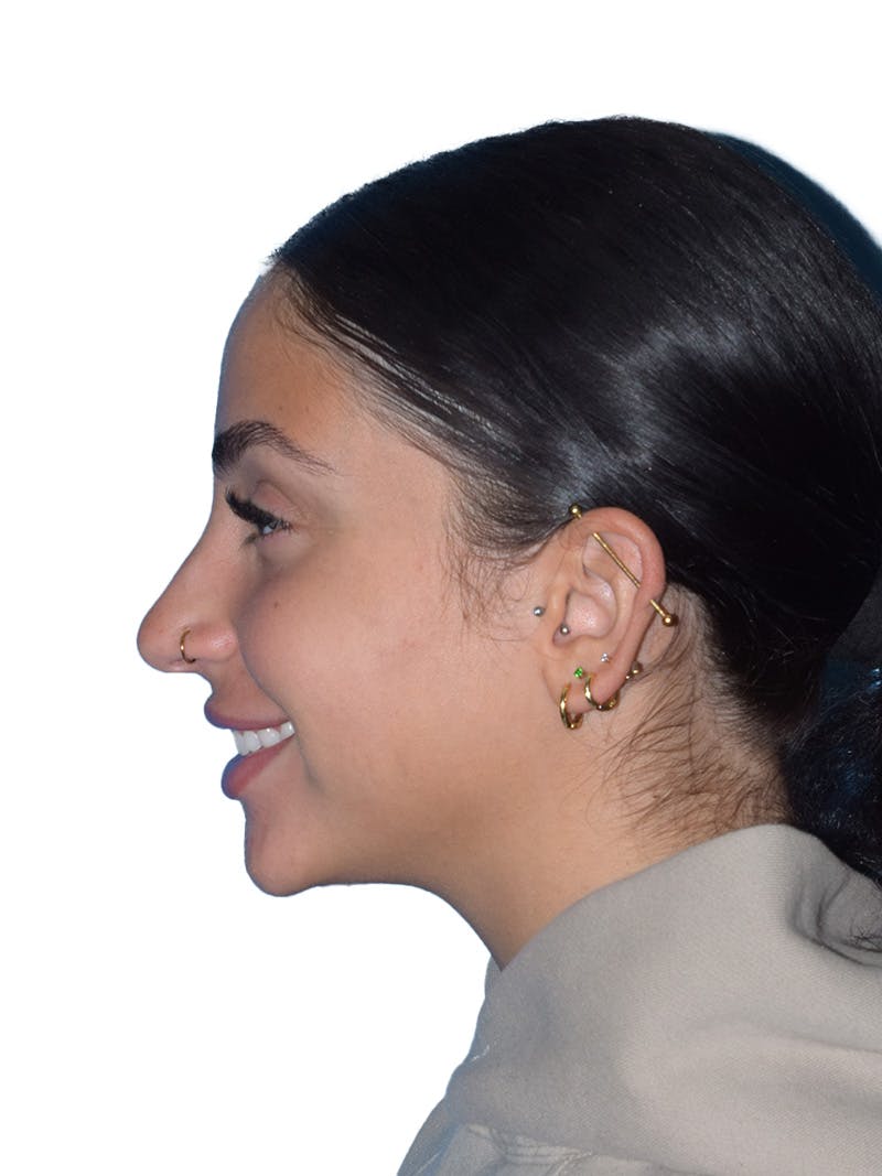 Rhinoplasty Before & After Gallery - Patient 394016 - Image 11