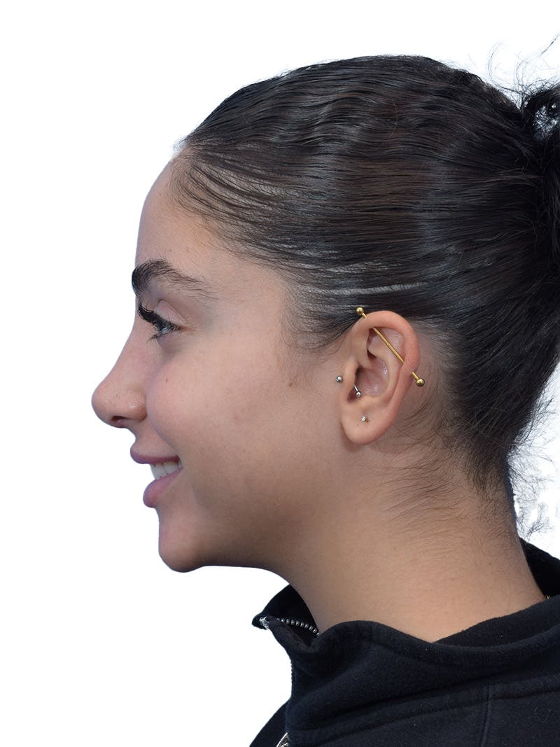 Rhinoplasty Before & After Gallery - Patient 394016 - Image 12