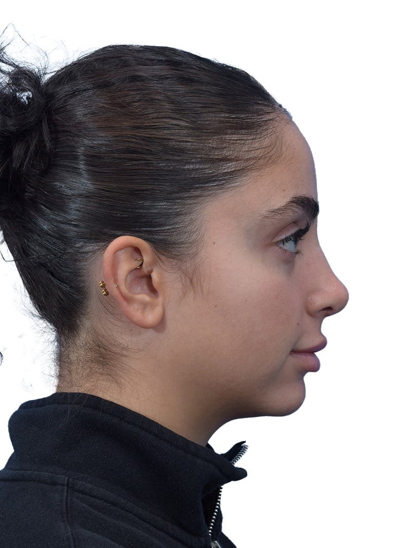 Rhinoplasty Before & After Gallery - Patient 394016 - Image 2