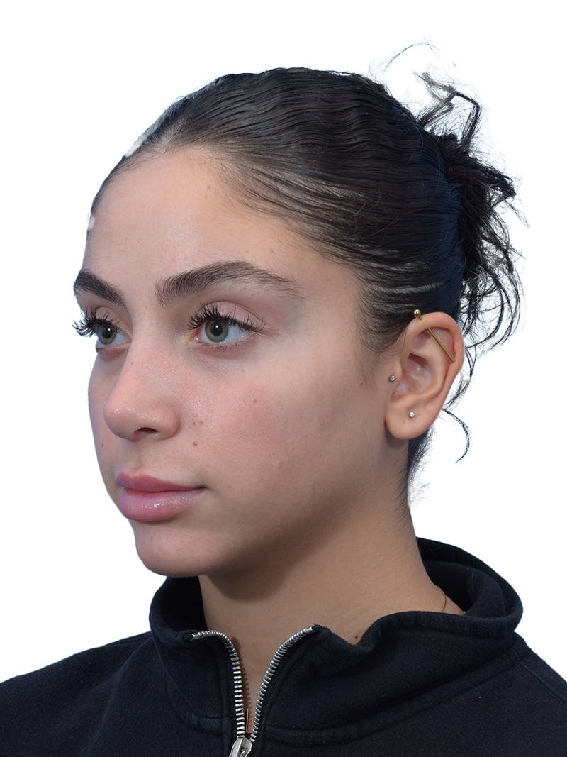 Rhinoplasty Before & After Gallery - Patient 394016 - Image 8