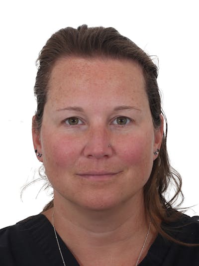 Blepharoplasty Before & After Gallery - Patient 228836 - Image 1