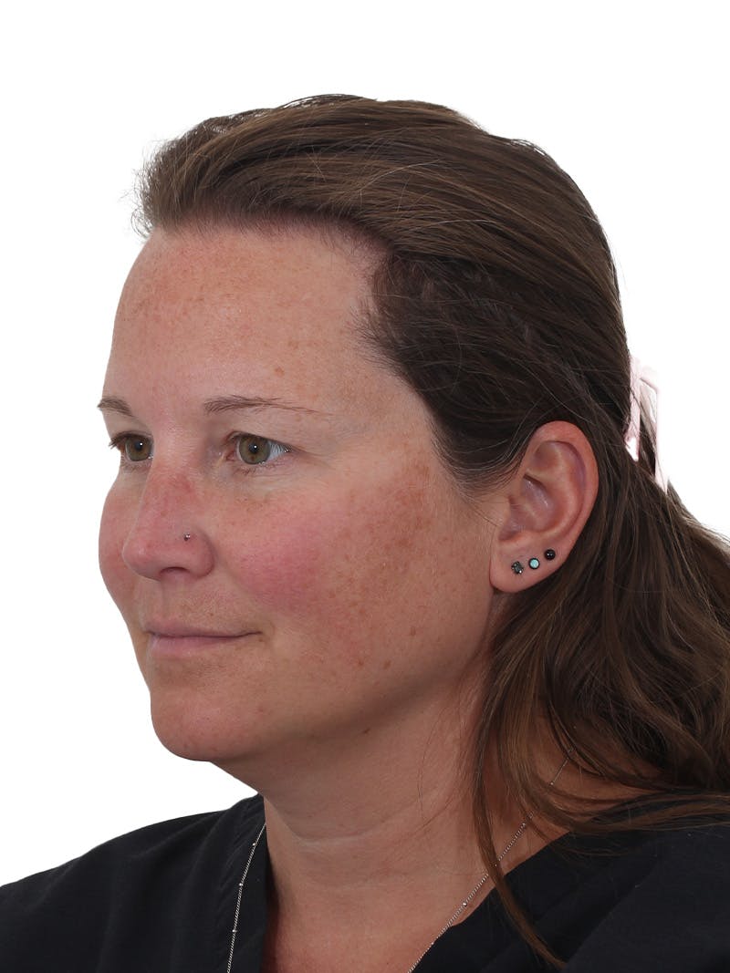 Submental Liposuction Before & After Gallery - Patient 130559 - Image 3