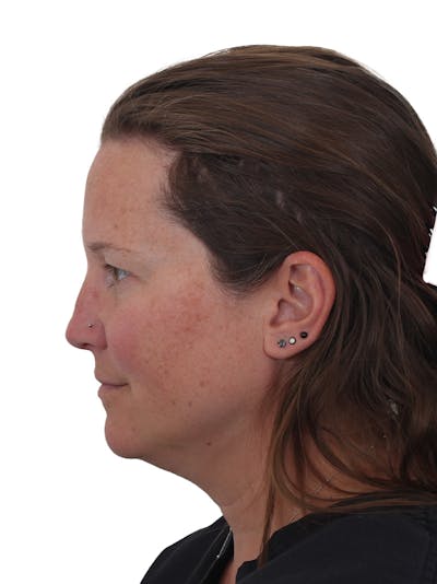 Submental Liposuction Before & After Gallery - Patient 130559 - Image 1