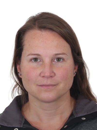 Blepharoplasty Before & After Gallery - Patient 228836 - Image 2