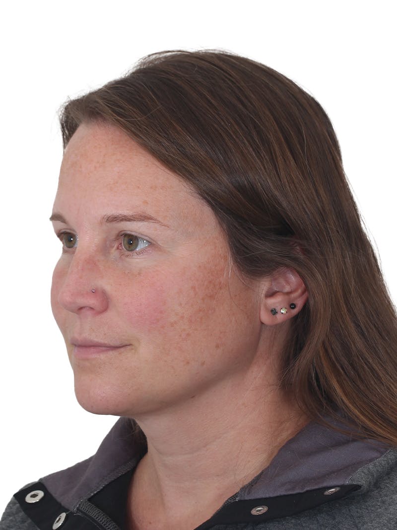 Submental Liposuction Before & After Gallery - Patient 130559 - Image 4