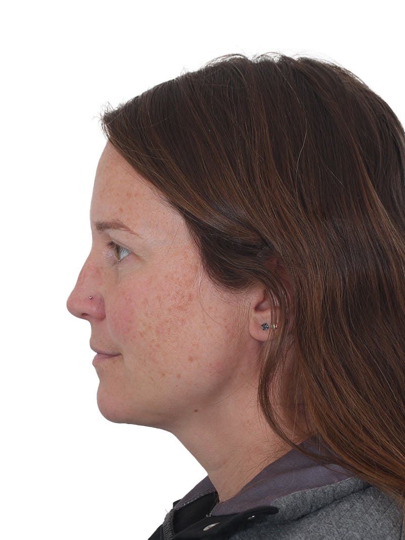 Submental Liposuction Before & After Gallery - Patient 130559 - Image 2