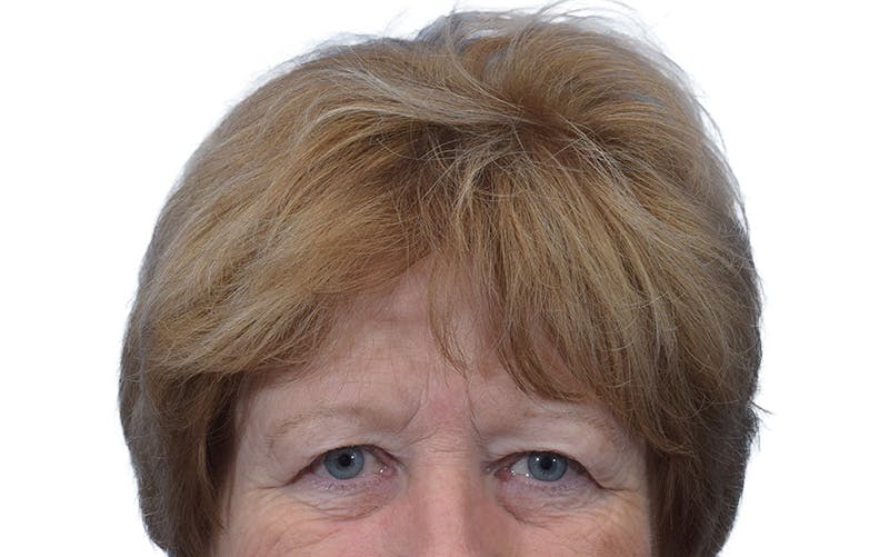 Brow Lift Before & After Gallery - Patient 384417 - Image 1