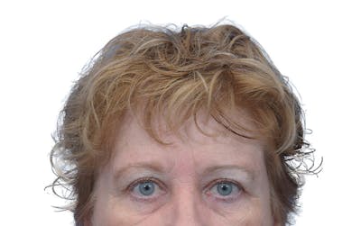 Blepharoplasty Before & After Gallery - Patient 195361 - Image 2