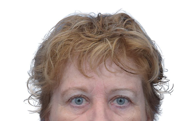 Brow Lift Before & After Gallery - Patient 384417 - Image 2