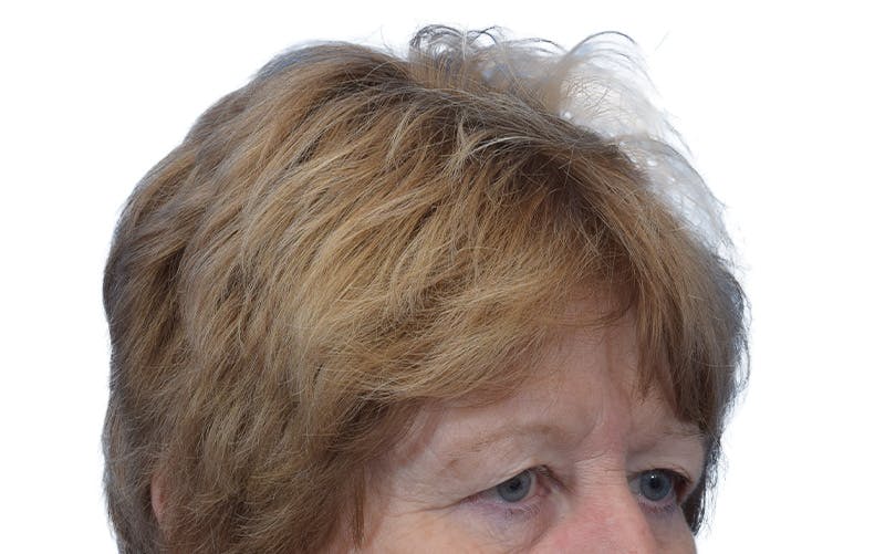 Brow Lift Before & After Gallery - Patient 384417 - Image 3