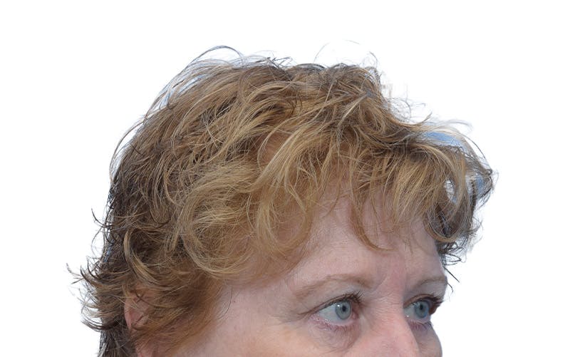 Brow Lift Before & After Gallery - Patient 384417 - Image 4