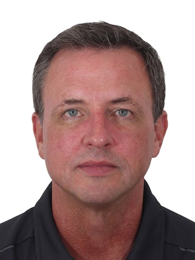 Blepharoplasty Before & After Gallery - Patient 223990 - Image 2