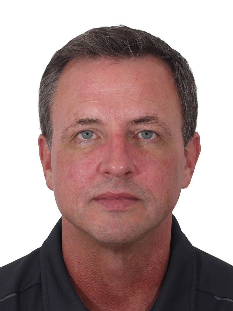 Fat Transfer Before & After Gallery - Patient 545356 - Image 2