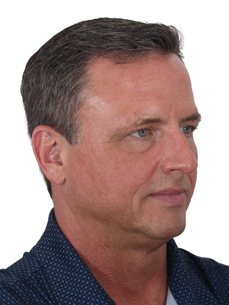 Fat Transfer Before & After Gallery - Patient 545356 - Image 3