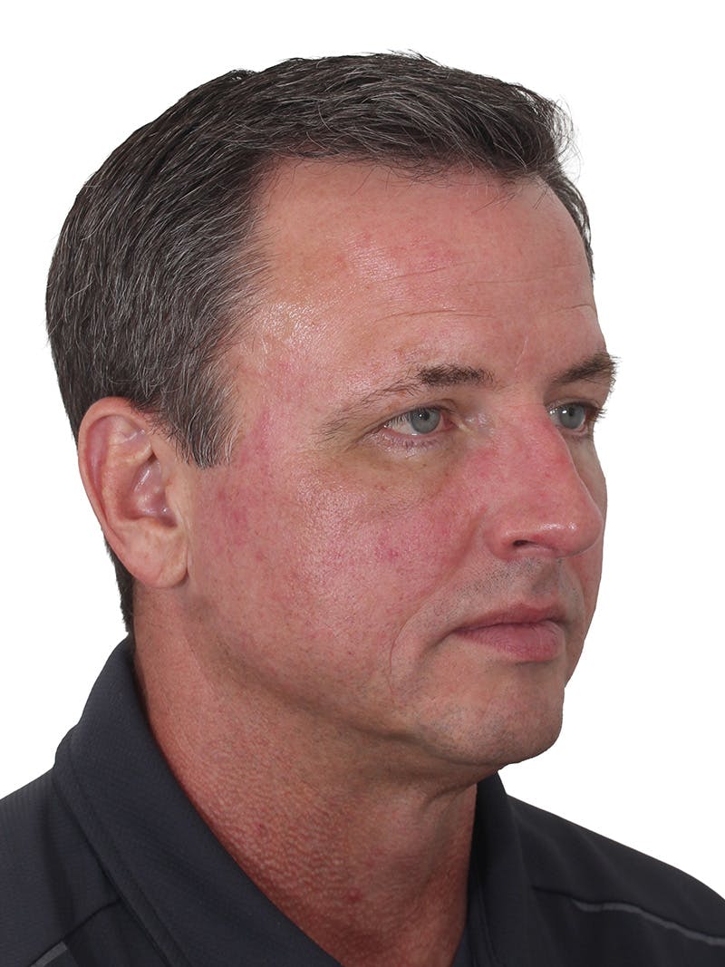 Fat Transfer Before & After Gallery - Patient 545356 - Image 4