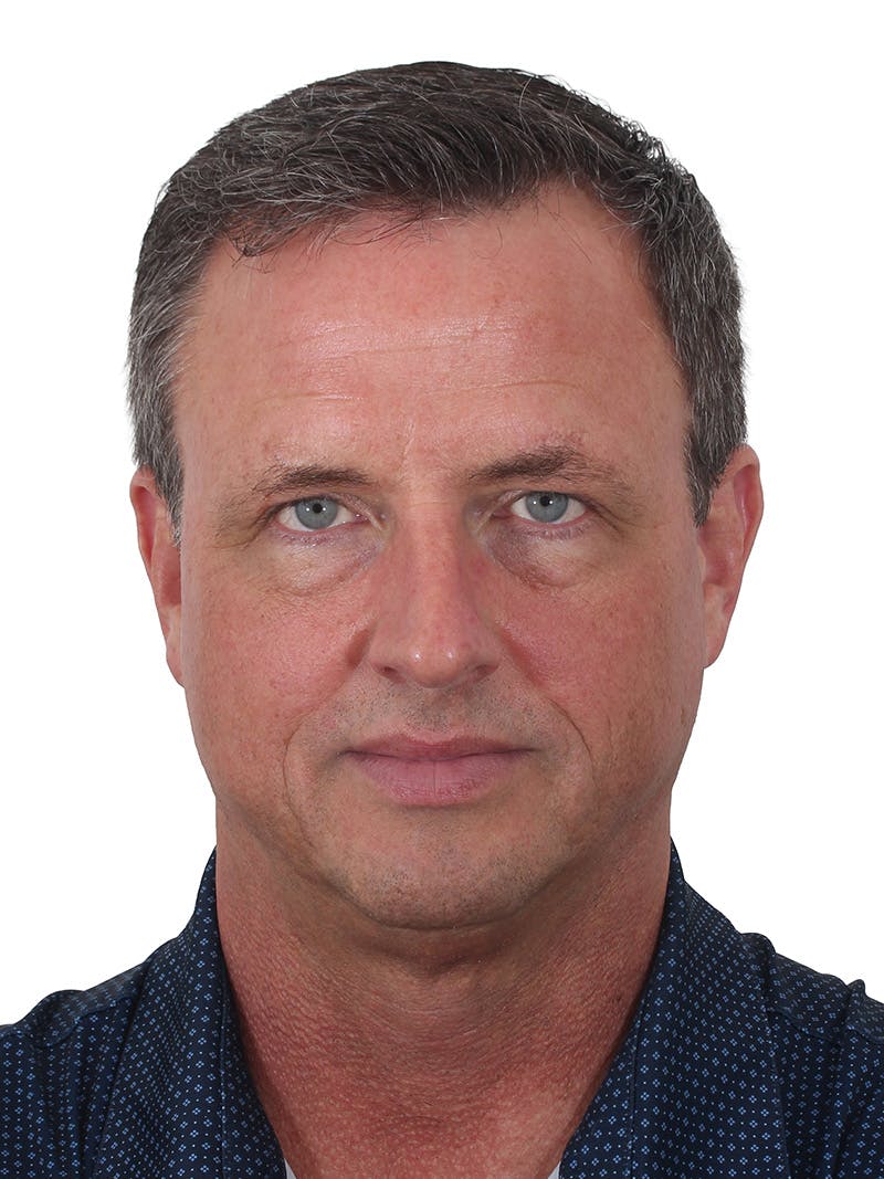 Fat Transfer Before & After Gallery - Patient 545356 - Image 1