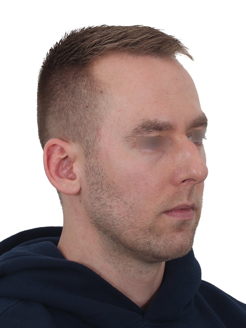 Rhinoplasty Before & After Gallery - Patient 195278 - Image 3