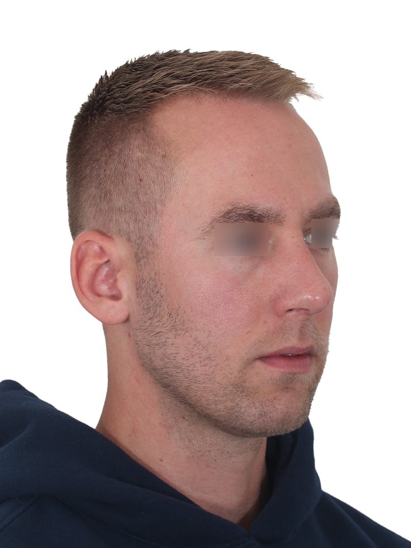 Rhinoplasty Before & After Gallery - Patient 195278 - Image 4