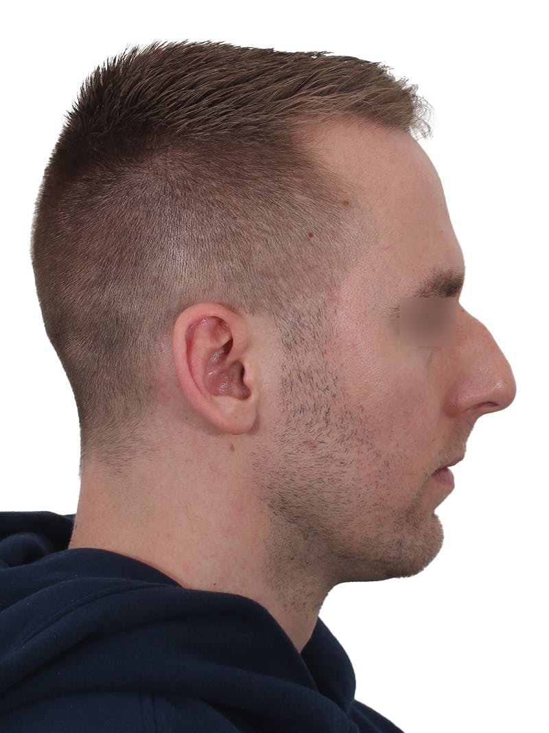Rhinoplasty Before & After Gallery - Patient 195278 - Image 1
