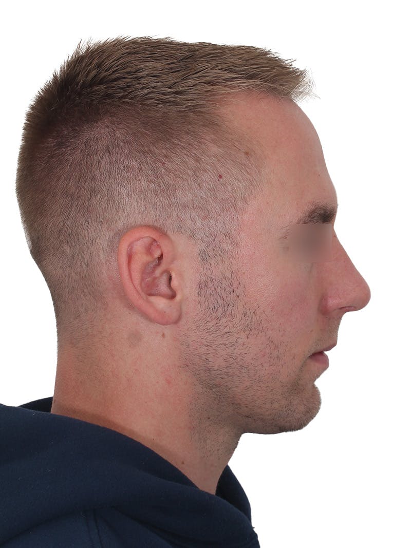 Rhinoplasty Before & After Gallery - Patient 195278 - Image 2