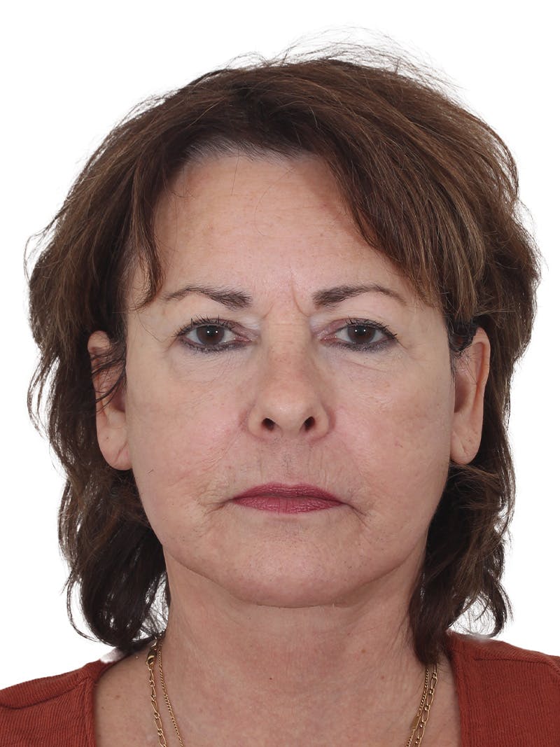 Facelift/Neck Lift Before & After Gallery - Patient 141509 - Image 6