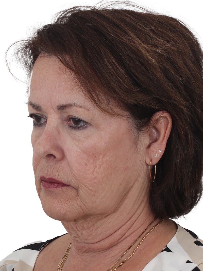 Facelift/Neck Lift Before & After Gallery - Patient 141509 - Image 3