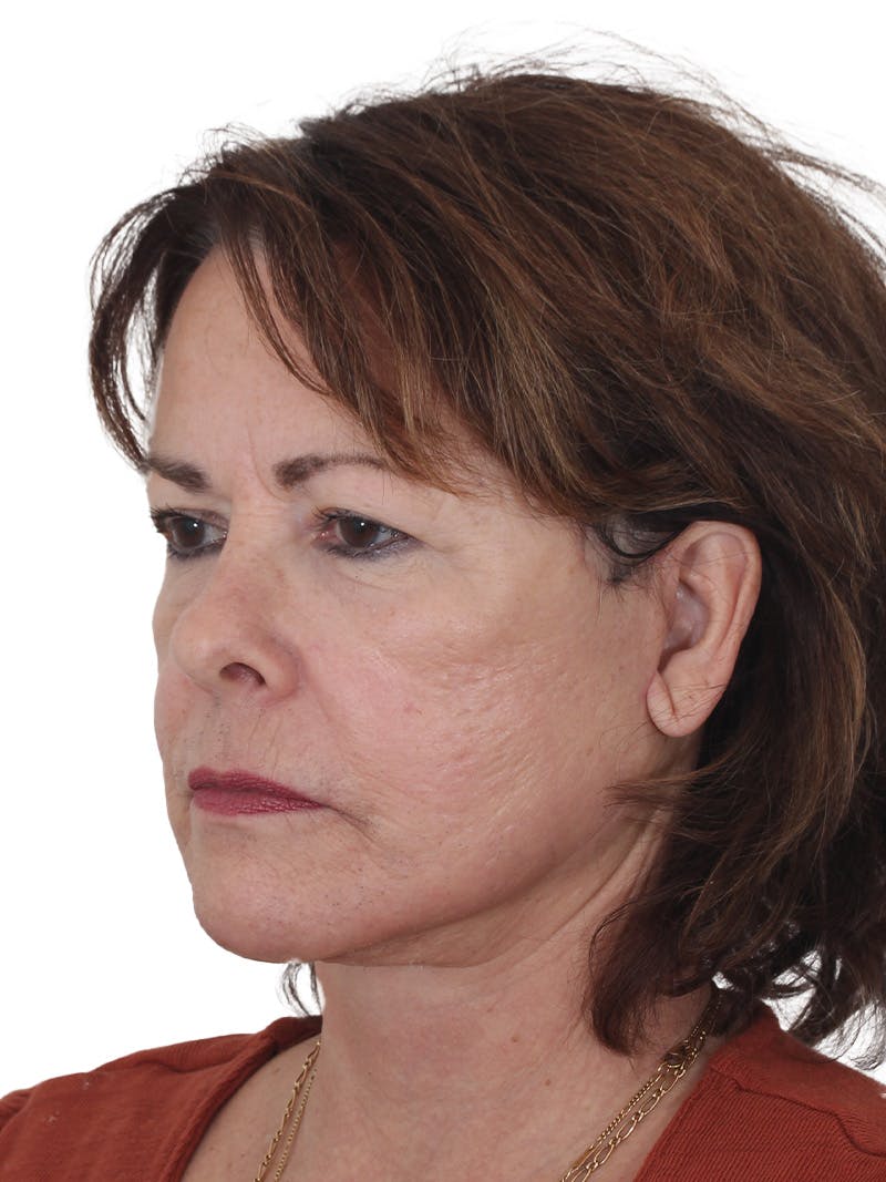 Facelift/Neck Lift Before & After Gallery - Patient 141509 - Image 4