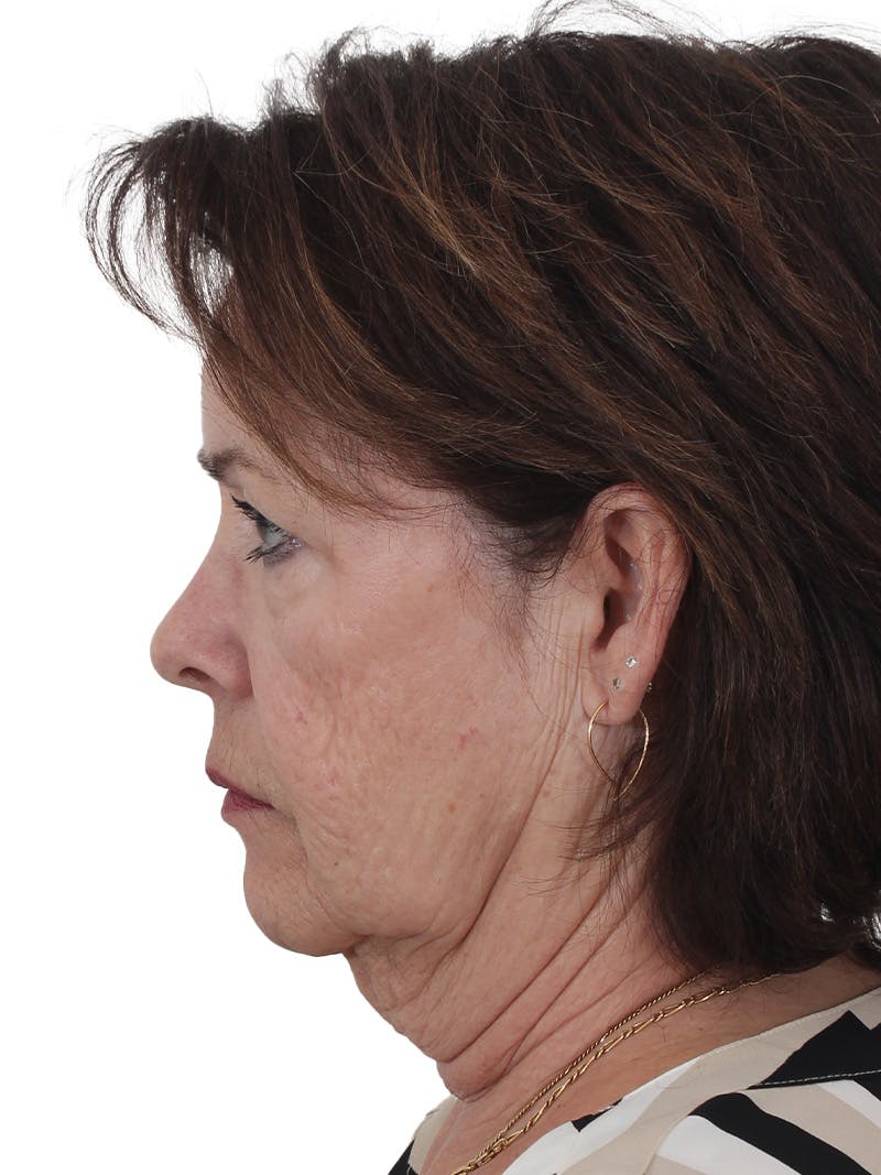 Facelift/Neck Lift Before & After Gallery - Patient 141509 - Image 1