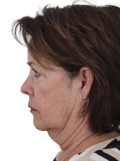 Facelift/Neck Lift Before & After Gallery - Patient 141509 - Image 1