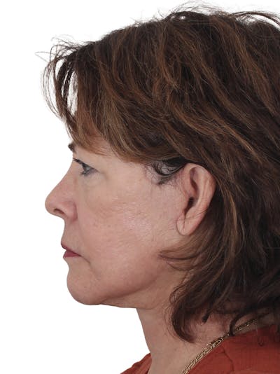 Facelift/Neck Lift Before & After Gallery - Patient 141509 - Image 2