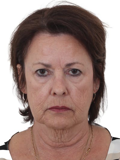 Laser Treatment Before & After Gallery - Patient 217934 - Image 1