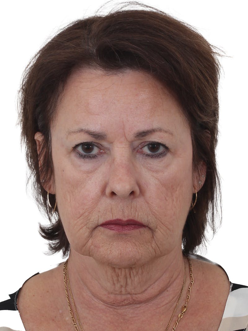 Facelift/Neck Lift Before & After Gallery - Patient 141509 - Image 5